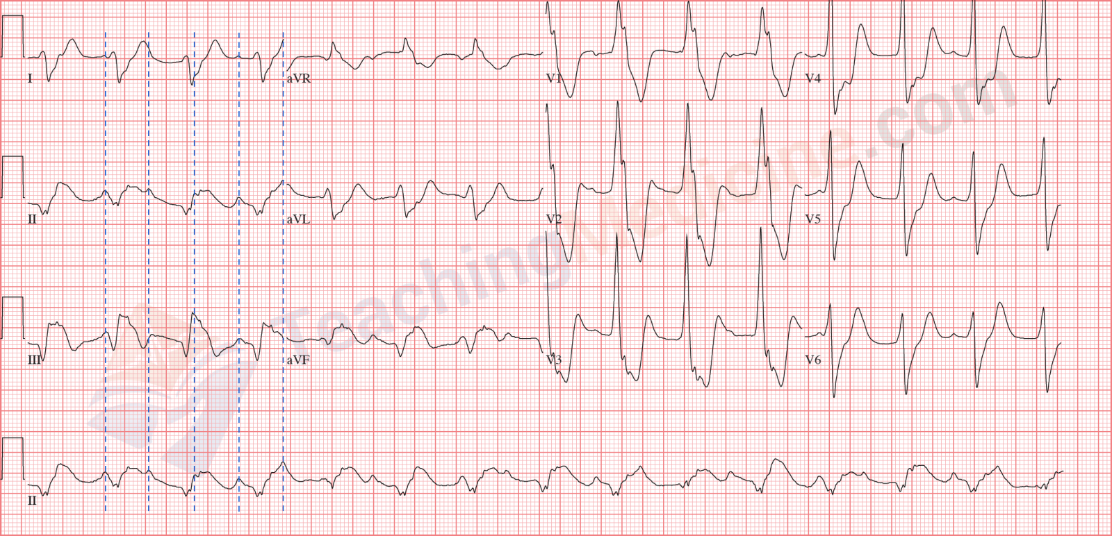 Third Degree Heart Block